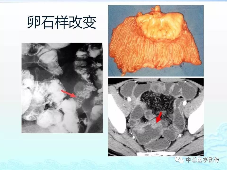 影像PPT - 【PPT】非肿瘤性肠道病变影像诊断-18