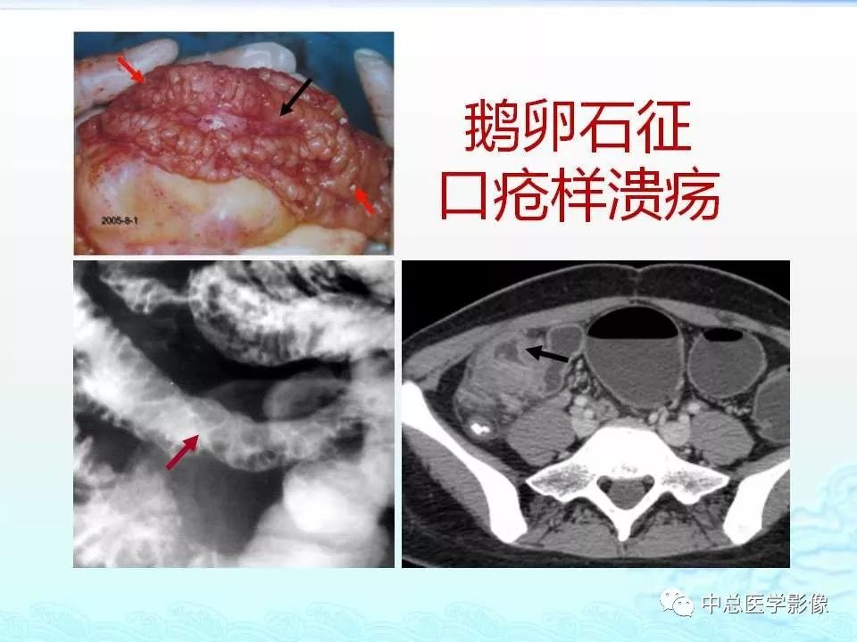 影像PPT - 【PPT】非肿瘤性肠道病变影像诊断-19