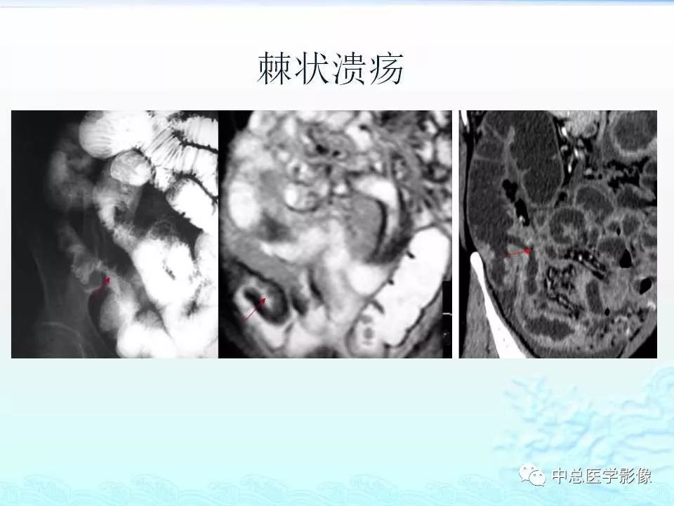 影像PPT - 【PPT】非肿瘤性肠道病变影像诊断-20