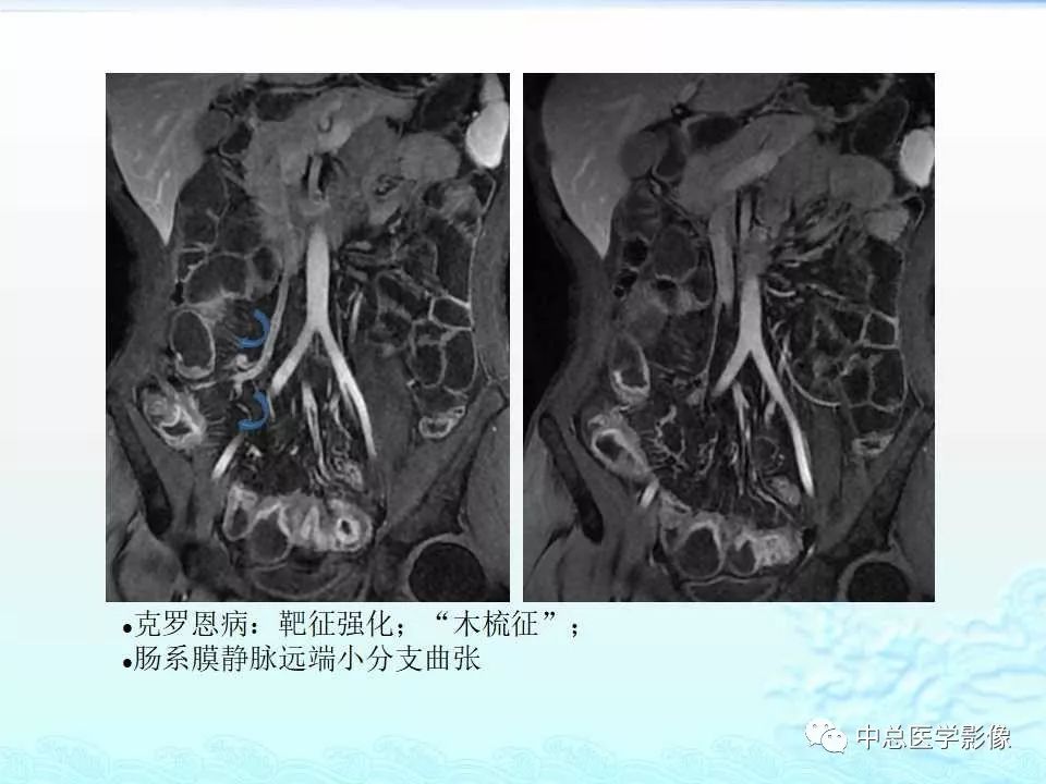 影像PPT - 【PPT】非肿瘤性肠道病变影像诊断-21