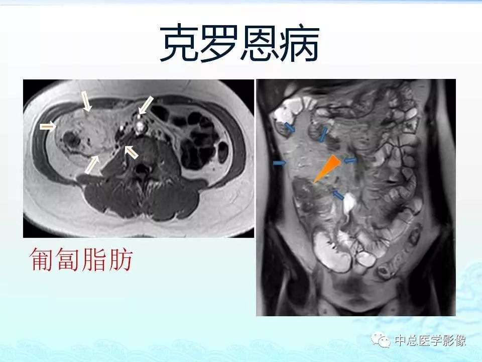 影像PPT - 【PPT】非肿瘤性肠道病变影像诊断-22