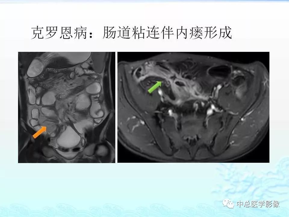 影像PPT - 【PPT】非肿瘤性肠道病变影像诊断-23