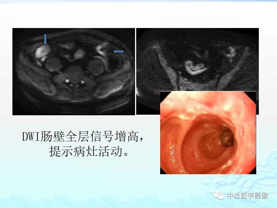 影像PPT - 【PPT】非肿瘤性肠道病变影像诊断-24