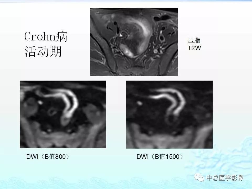 影像PPT - 【PPT】非肿瘤性肠道病变影像诊断-25