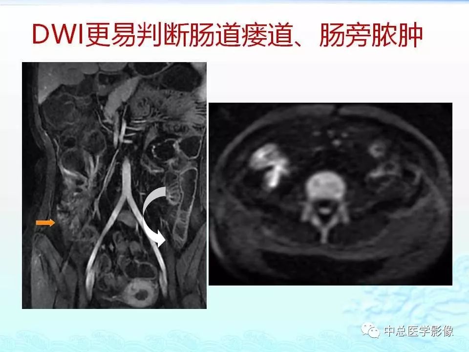 影像PPT - 【PPT】非肿瘤性肠道病变影像诊断-26