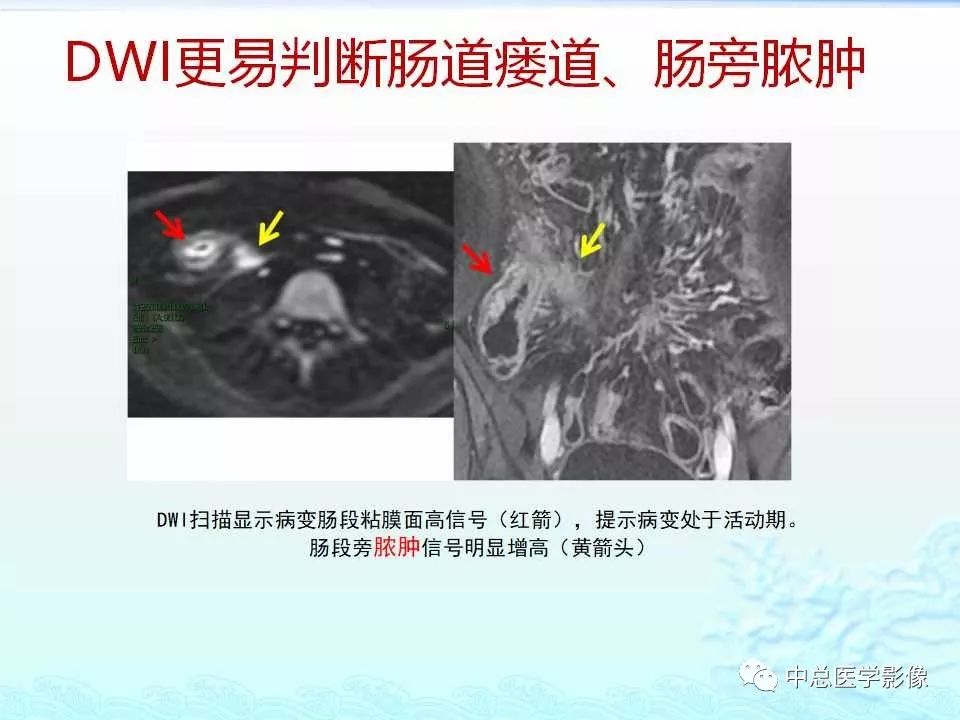 影像PPT - 【PPT】非肿瘤性肠道病变影像诊断-27