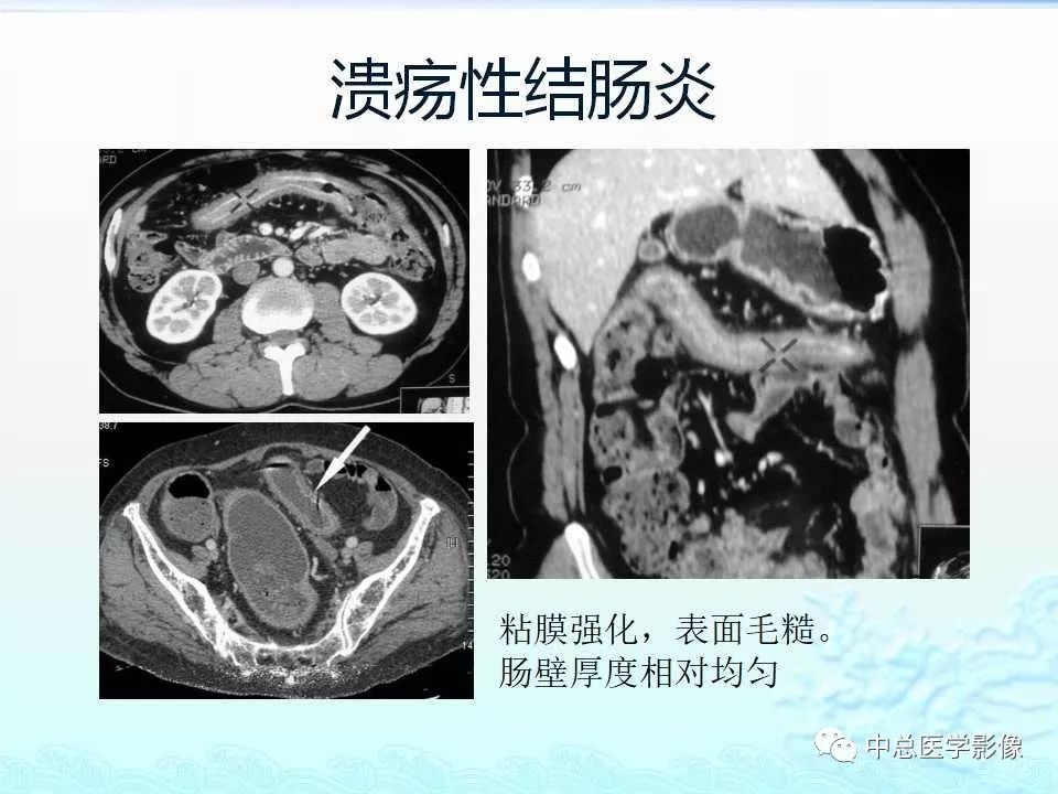 影像PPT - 【PPT】非肿瘤性肠道病变影像诊断-28