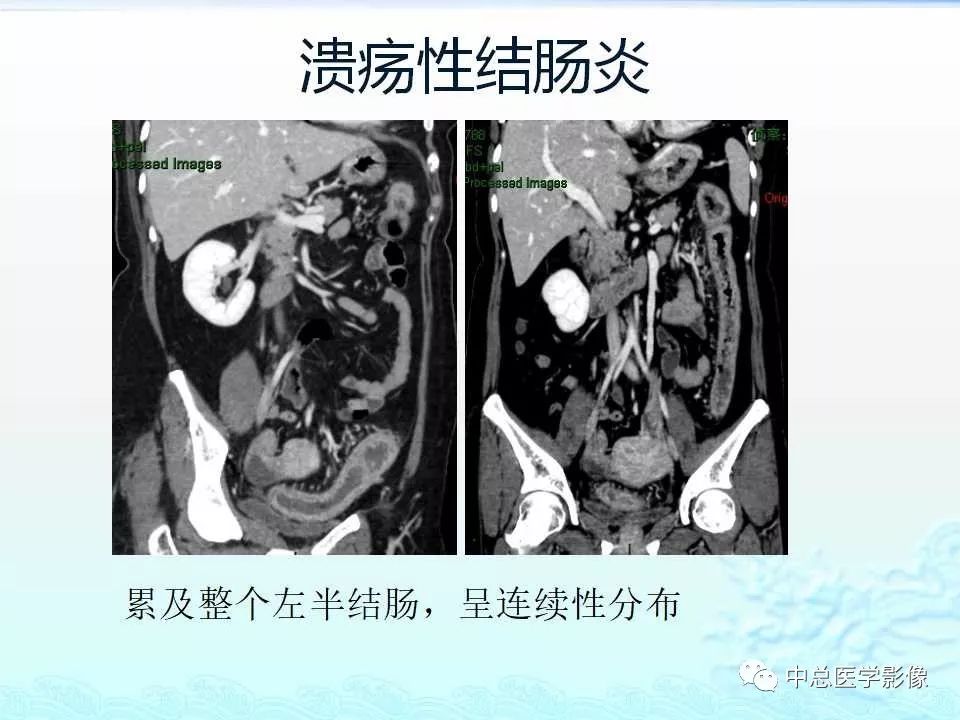 影像PPT - 【PPT】非肿瘤性肠道病变影像诊断-30