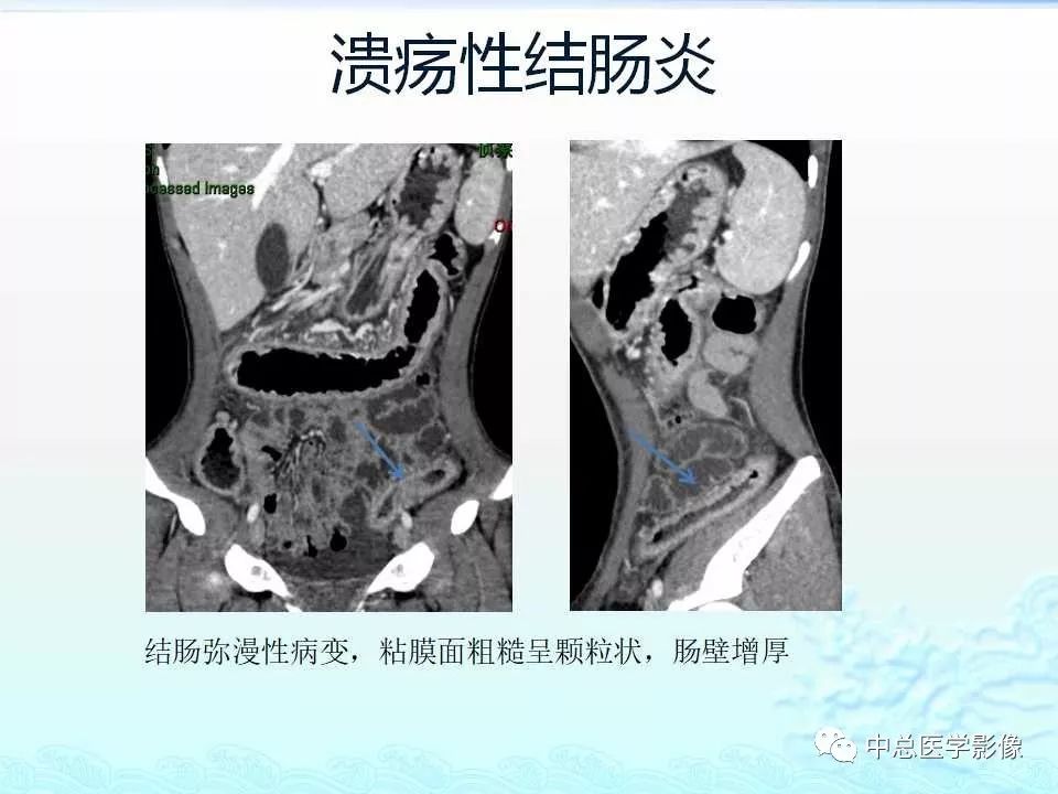 影像PPT - 【PPT】非肿瘤性肠道病变影像诊断-29