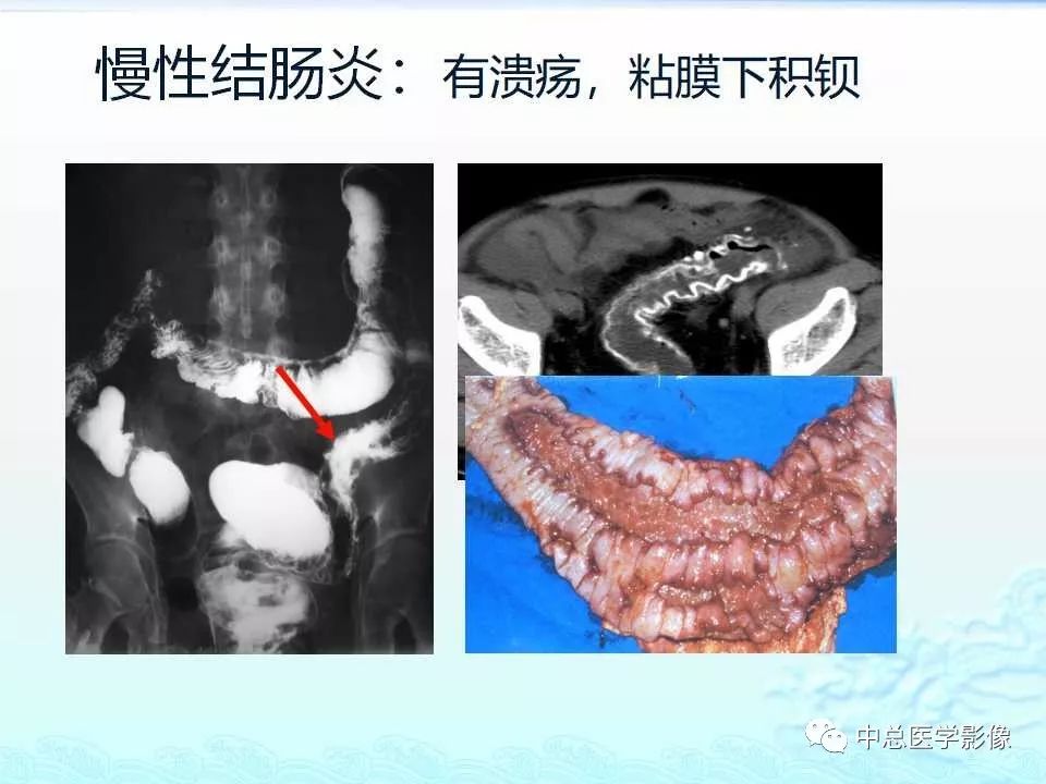 影像PPT - 【PPT】非肿瘤性肠道病变影像诊断-31