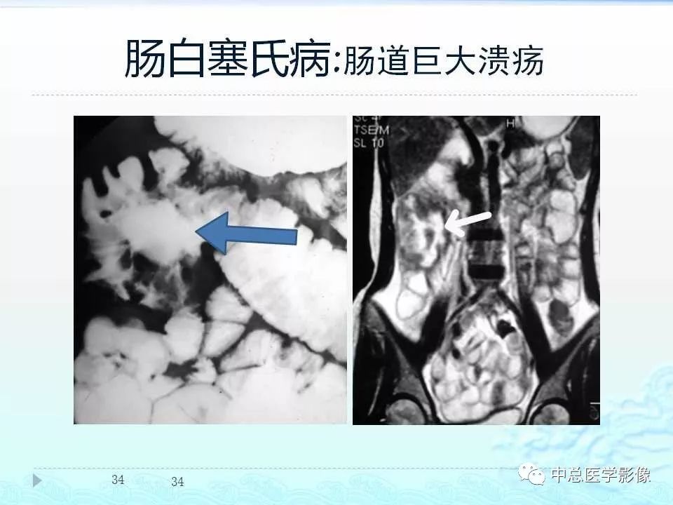 影像PPT - 【PPT】非肿瘤性肠道病变影像诊断-33