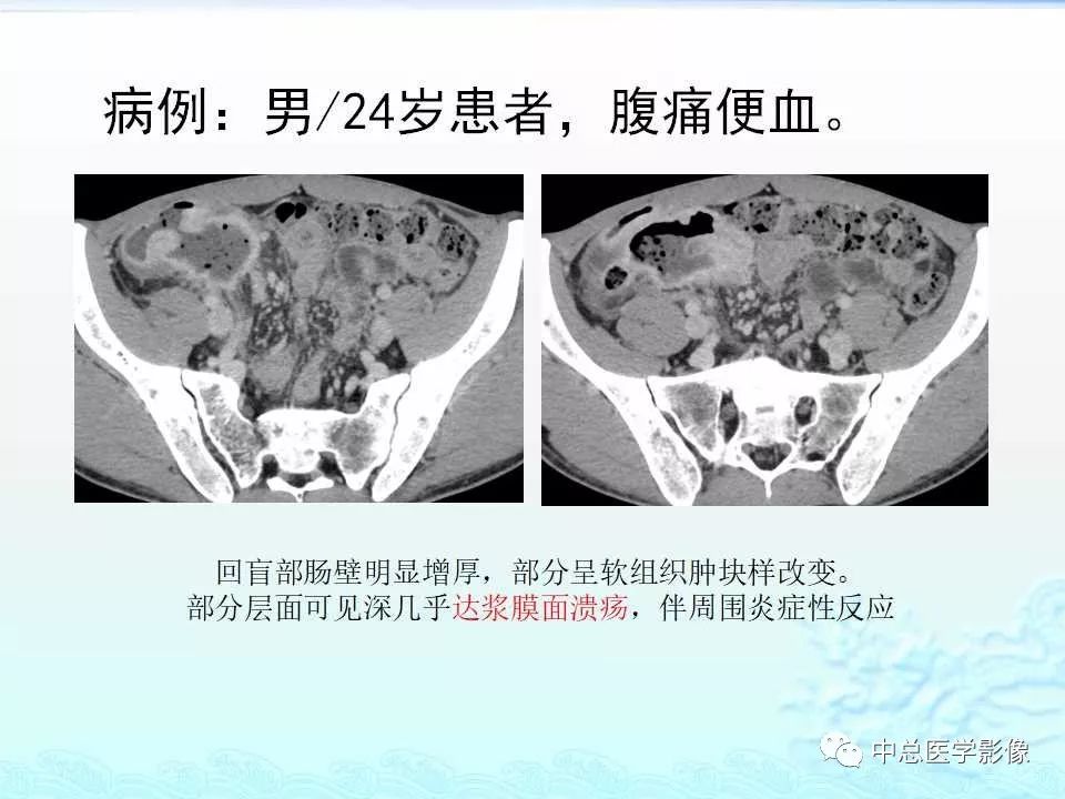 影像PPT - 【PPT】非肿瘤性肠道病变影像诊断-34