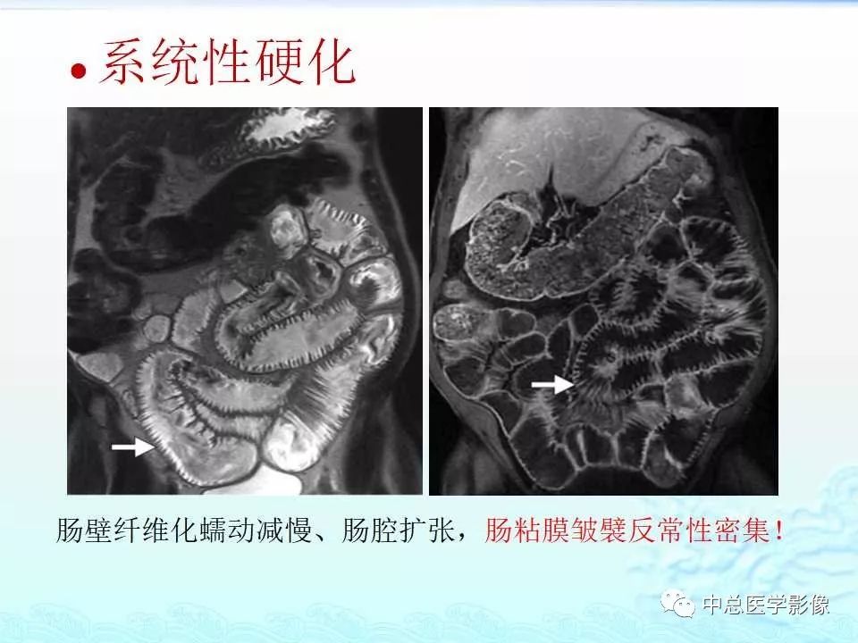 影像PPT - 【PPT】非肿瘤性肠道病变影像诊断-36