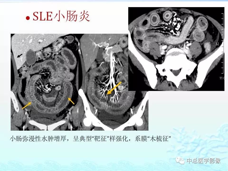 影像PPT - 【PPT】非肿瘤性肠道病变影像诊断-35