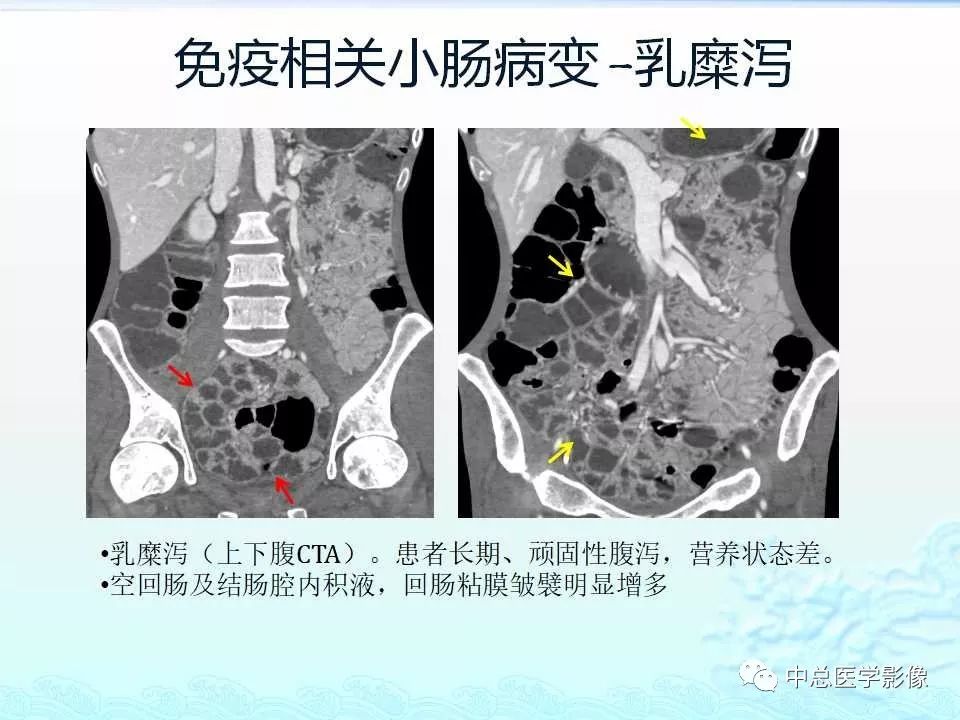 影像PPT - 【PPT】非肿瘤性肠道病变影像诊断-37