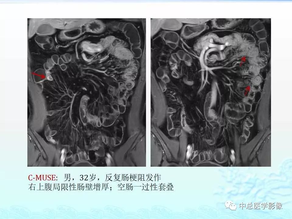 影像PPT - 【PPT】非肿瘤性肠道病变影像诊断-43