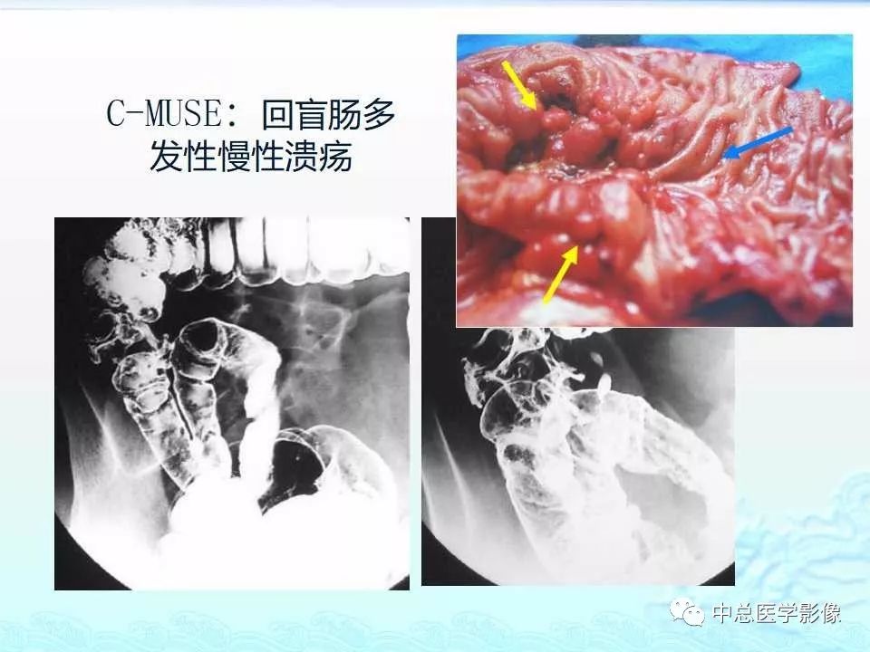 影像PPT - 【PPT】非肿瘤性肠道病变影像诊断-41