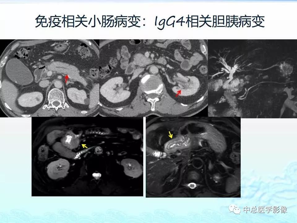 影像PPT - 【PPT】非肿瘤性肠道病变影像诊断-38