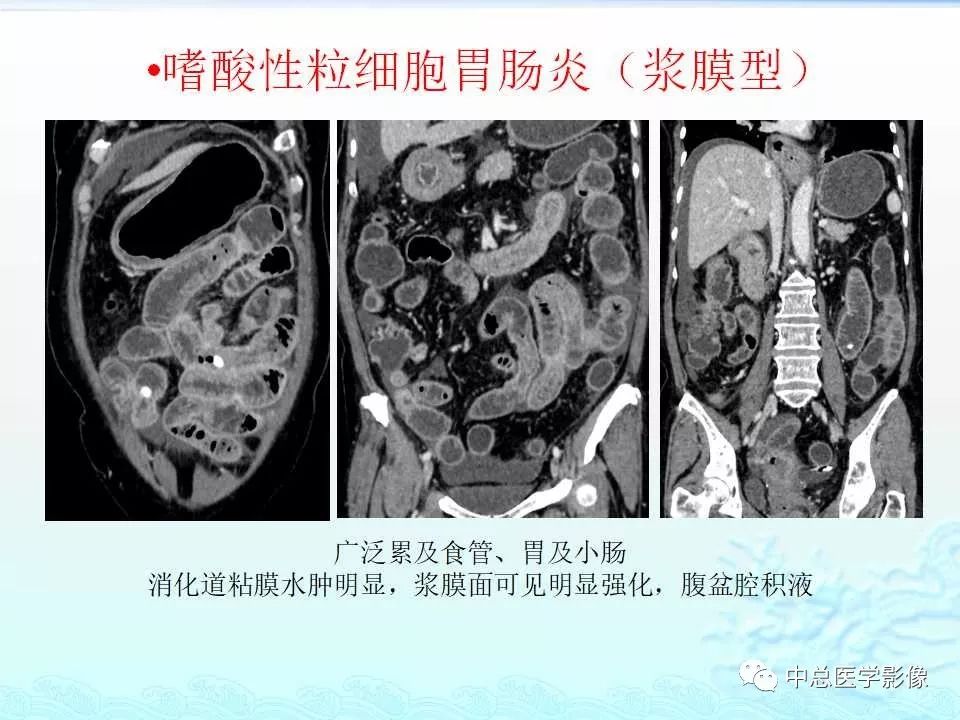 影像PPT - 【PPT】非肿瘤性肠道病变影像诊断-39