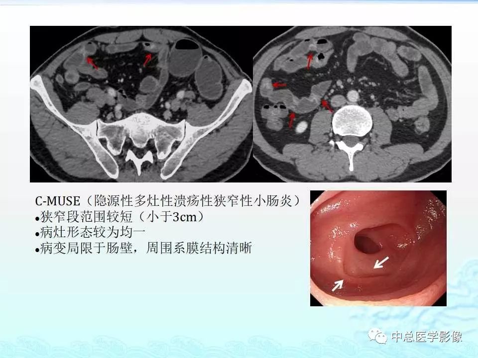 影像PPT - 【PPT】非肿瘤性肠道病变影像诊断-42