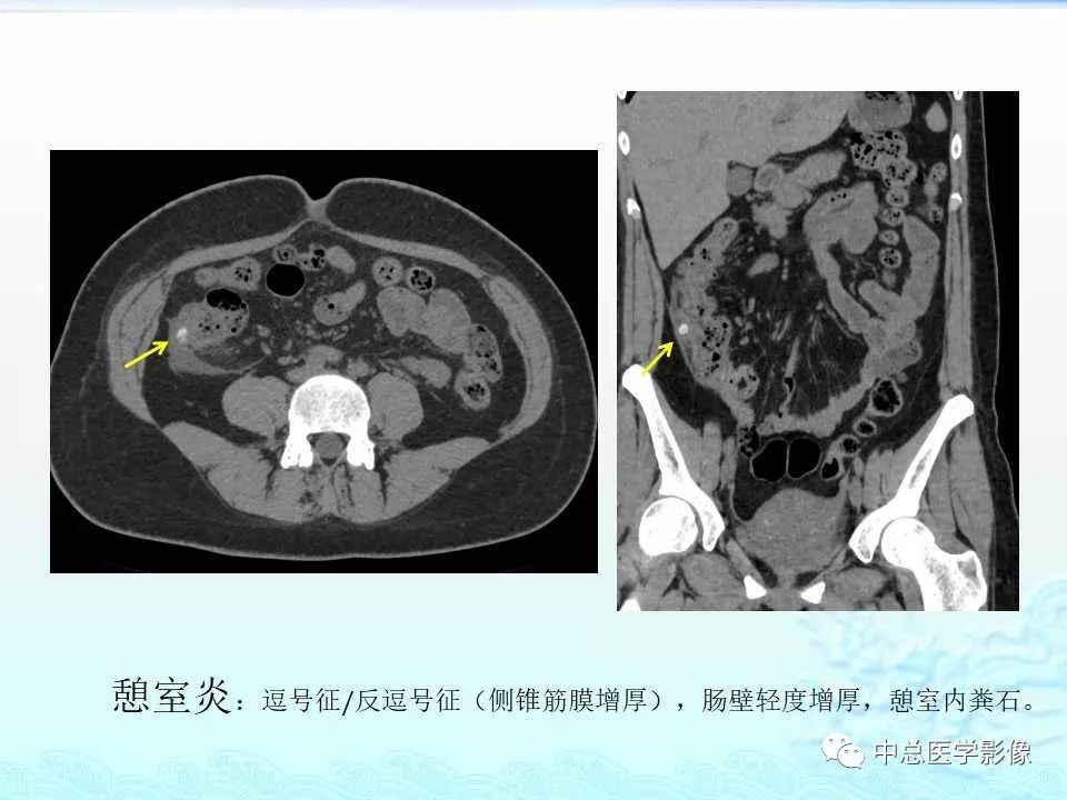 影像PPT - 【PPT】非肿瘤性肠道病变影像诊断-45