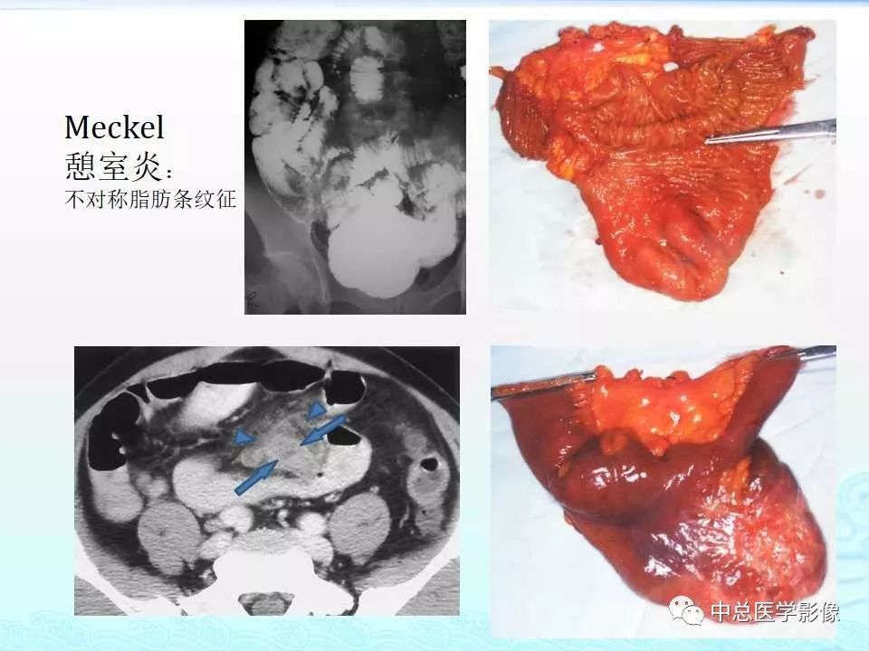 影像PPT - 【PPT】非肿瘤性肠道病变影像诊断-44