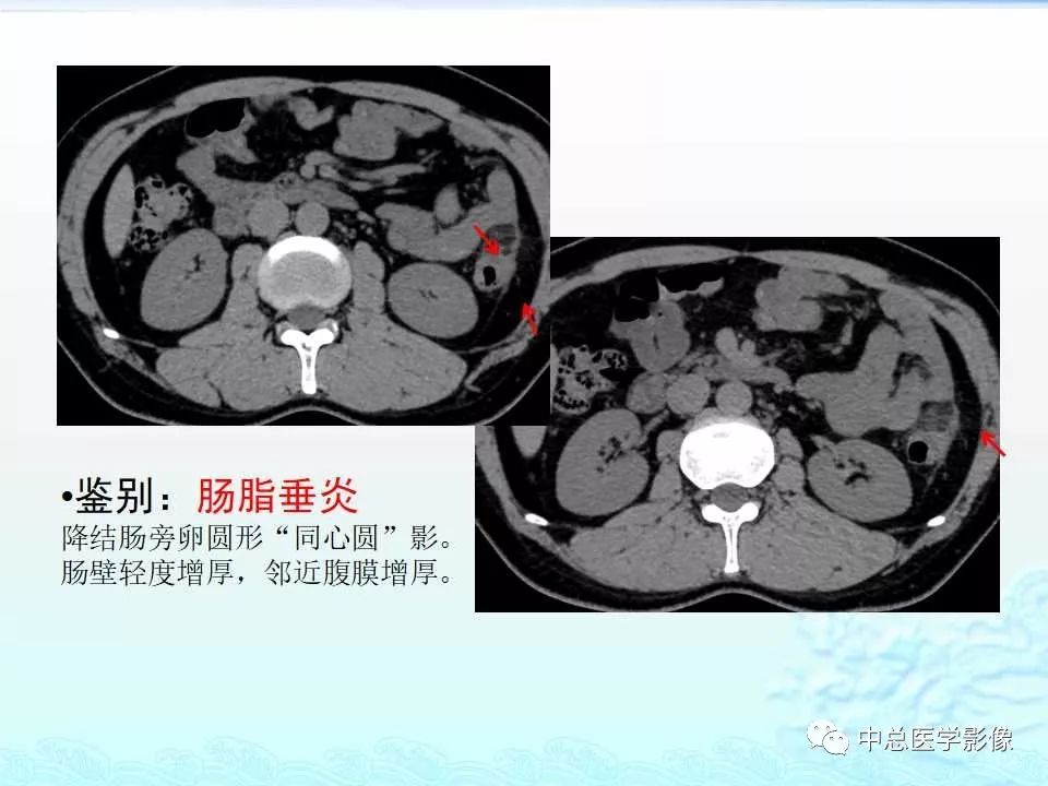 影像PPT - 【PPT】非肿瘤性肠道病变影像诊断-46