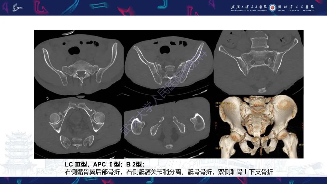 影像PPT - 【PPT】骨盆骨折合并血管损伤CT诊断-5