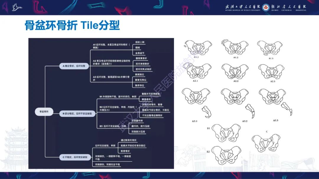 影像PPT - 【PPT】骨盆骨折合并血管损伤CT诊断-4