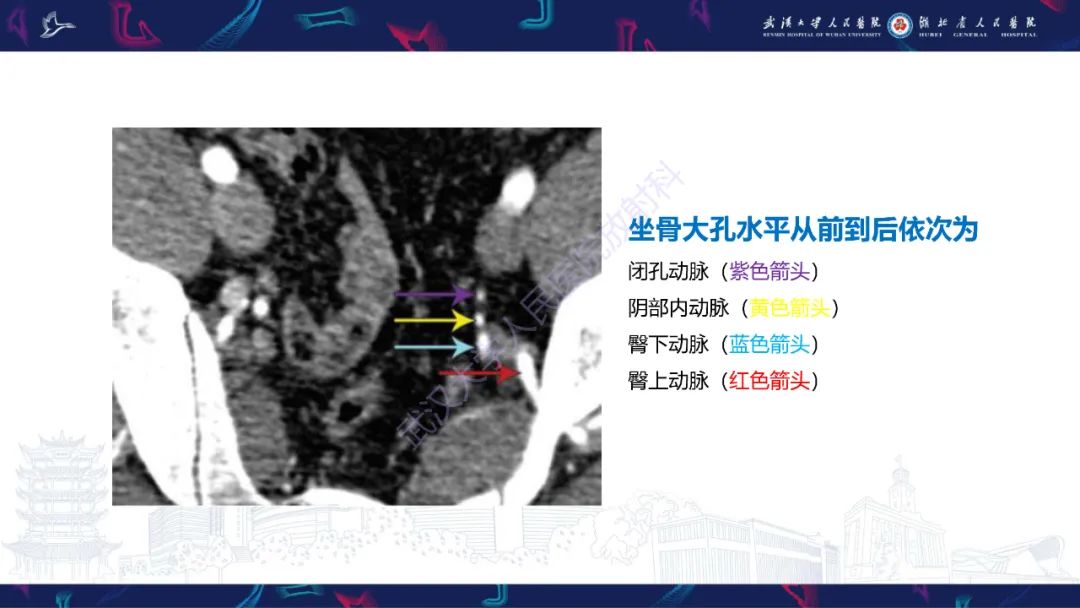 影像PPT - 【PPT】骨盆骨折合并血管损伤CT诊断-8