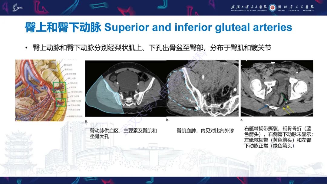 影像PPT - 【PPT】骨盆骨折合并血管损伤CT诊断-11