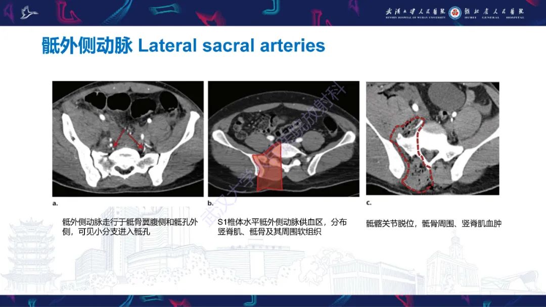 影像PPT - 【PPT】骨盆骨折合并血管损伤CT诊断-10