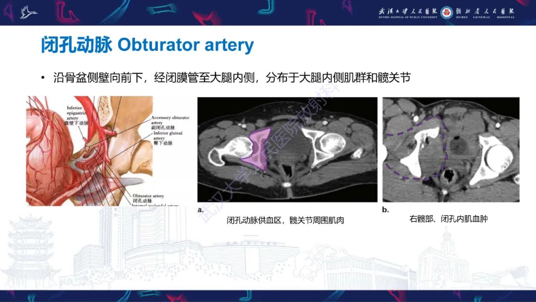 影像PPT - 【PPT】骨盆骨折合并血管损伤CT诊断-12