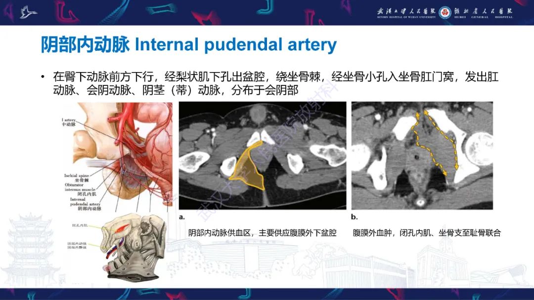 影像PPT - 【PPT】骨盆骨折合并血管损伤CT诊断-13