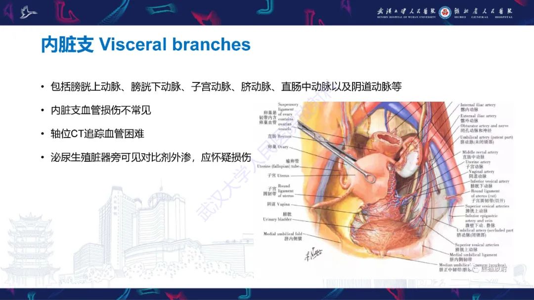 影像PPT - 【PPT】骨盆骨折合并血管损伤CT诊断-16