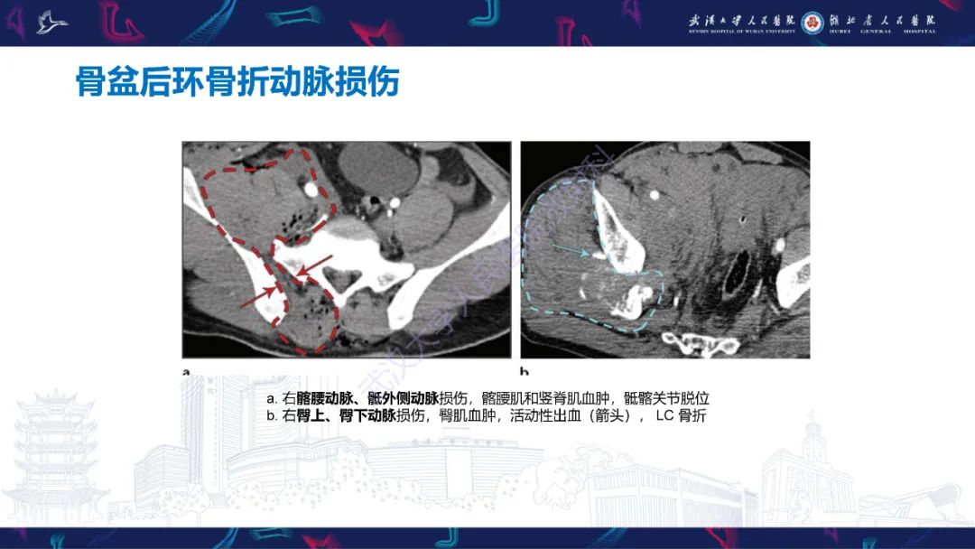 影像PPT - 【PPT】骨盆骨折合并血管损伤CT诊断-18