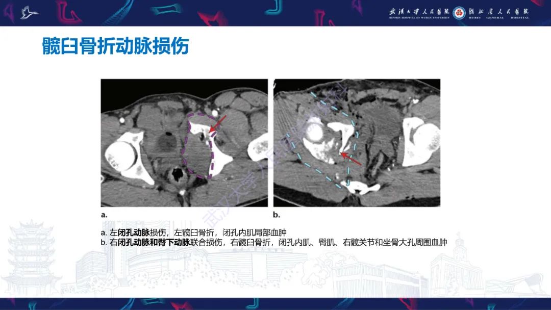 影像PPT - 【PPT】骨盆骨折合并血管损伤CT诊断-19