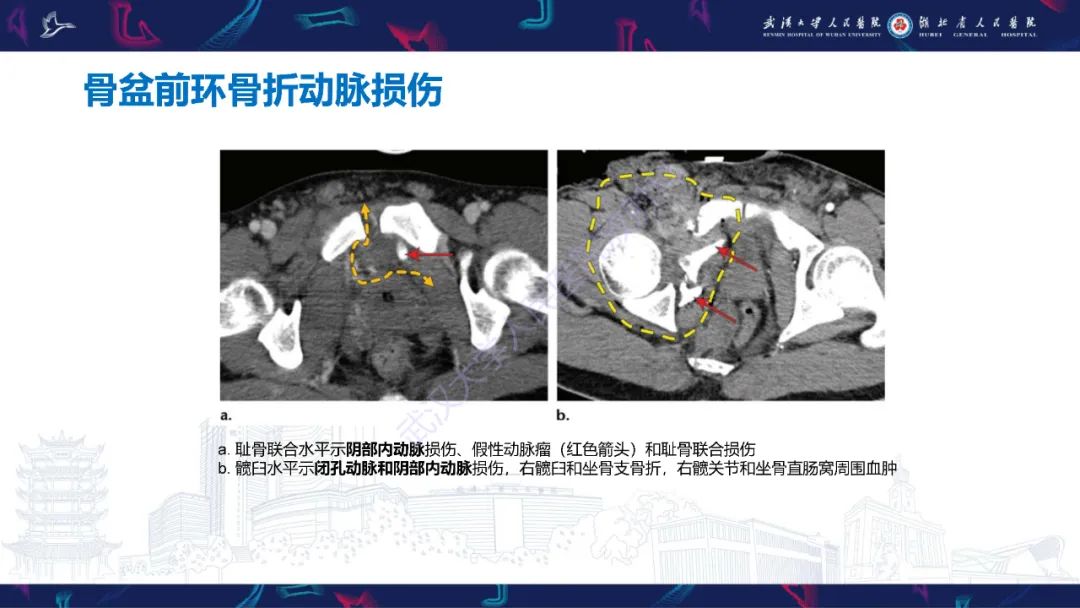 影像PPT - 【PPT】骨盆骨折合并血管损伤CT诊断-20