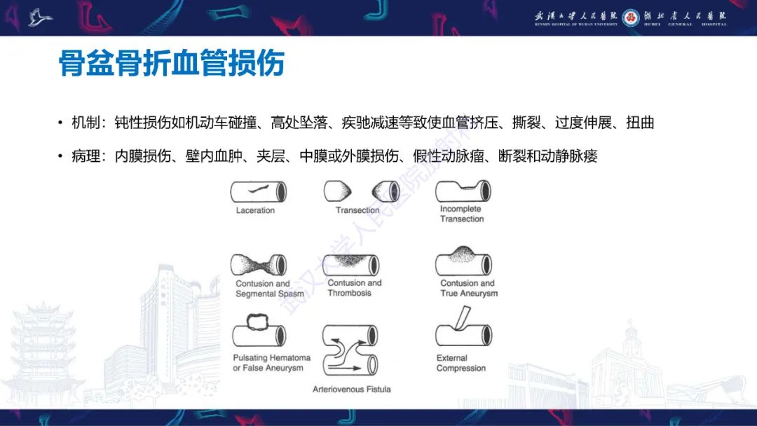影像PPT - 【PPT】骨盆骨折合并血管损伤CT诊断-23