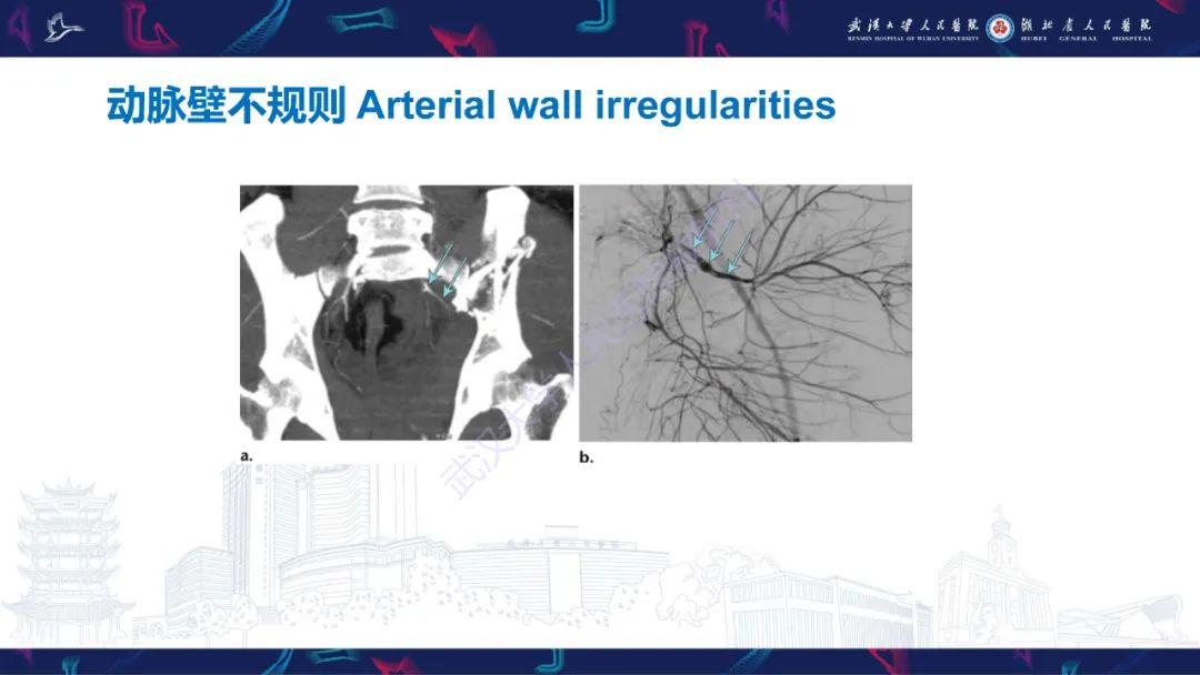 影像PPT - 【PPT】骨盆骨折合并血管损伤CT诊断-25