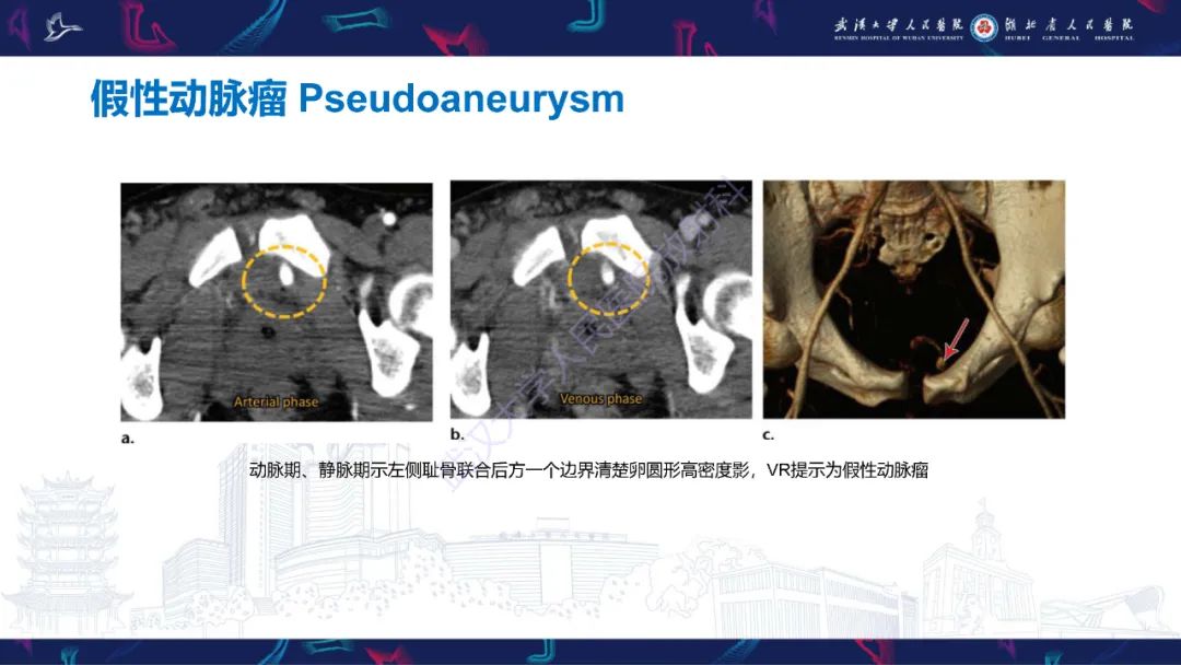 影像PPT - 【PPT】骨盆骨折合并血管损伤CT诊断-29