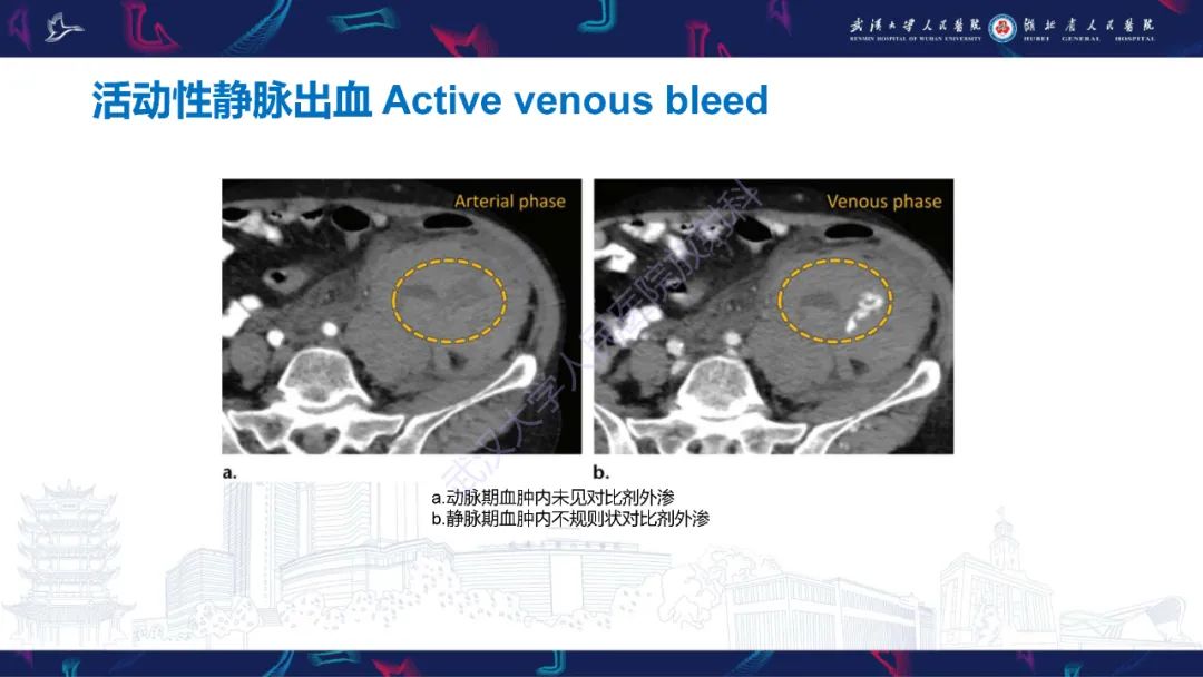影像PPT - 【PPT】骨盆骨折合并血管损伤CT诊断-28