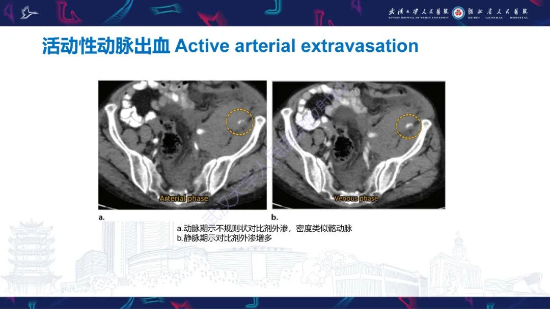 影像PPT - 【PPT】骨盆骨折合并血管损伤CT诊断-27