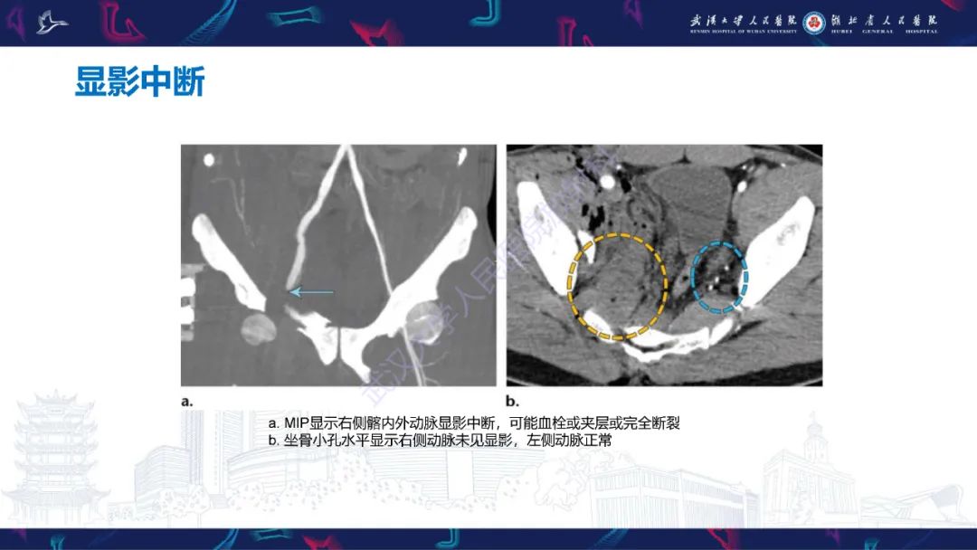 影像PPT - 【PPT】骨盆骨折合并血管损伤CT诊断-26