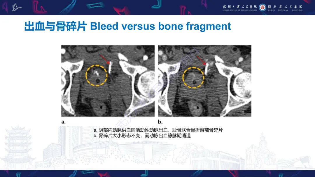 影像PPT - 【PPT】骨盆骨折合并血管损伤CT诊断-32