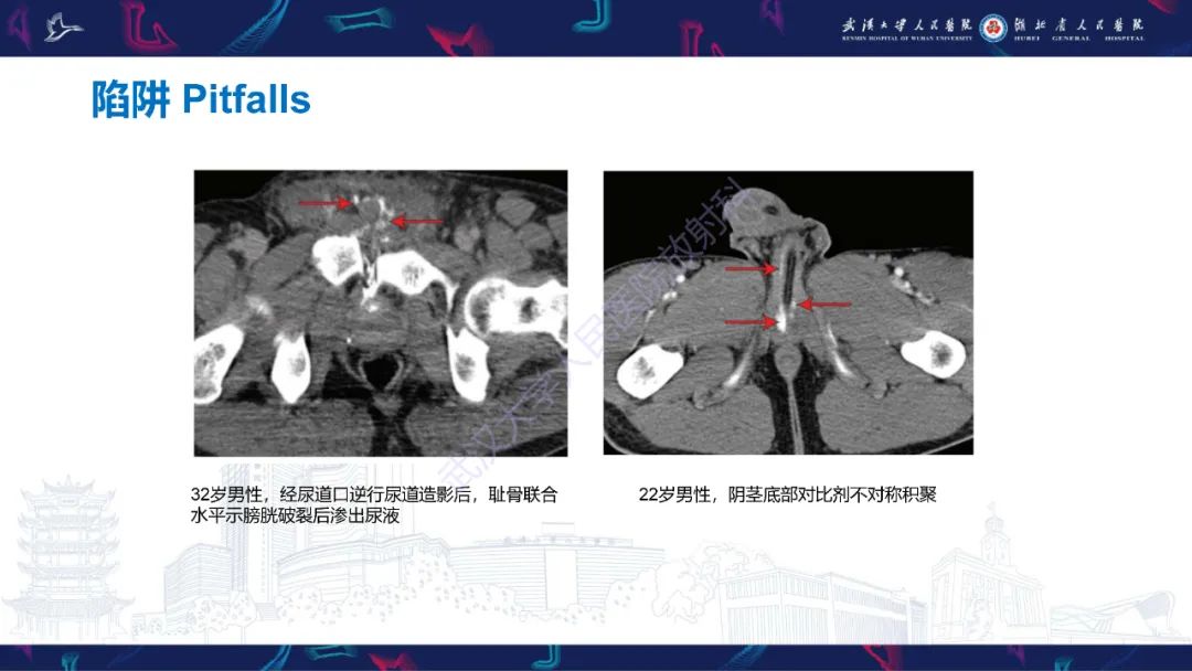 影像PPT - 【PPT】骨盆骨折合并血管损伤CT诊断-33