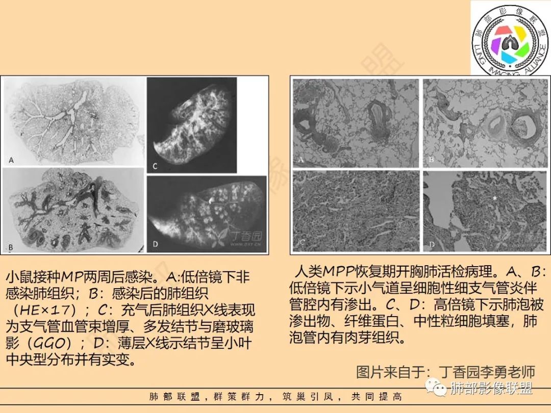 影像PPT - 【PPT】肺炎支原体肺炎影像分析-7 影像PPT - 【PPT】肺炎支原体肺炎影像分析-7