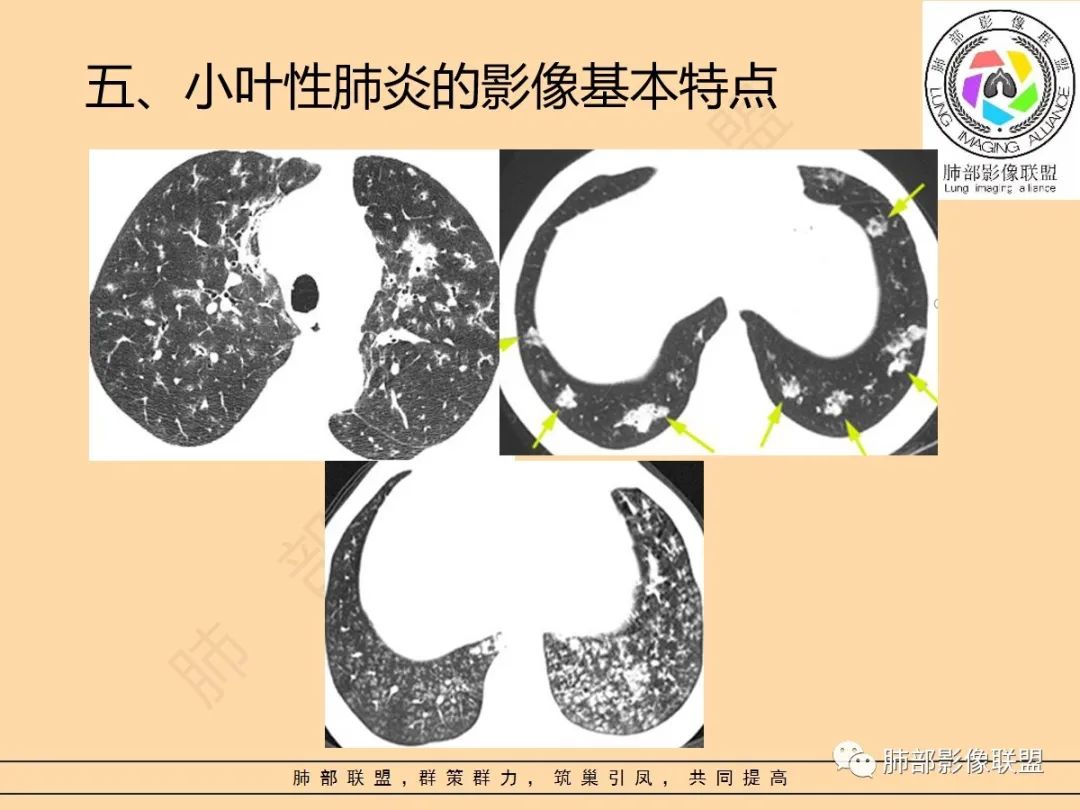影像PPT - 【PPT】肺炎支原体肺炎影像分析-12 影像PPT - 【PPT】肺炎支原体肺炎影像分析-12