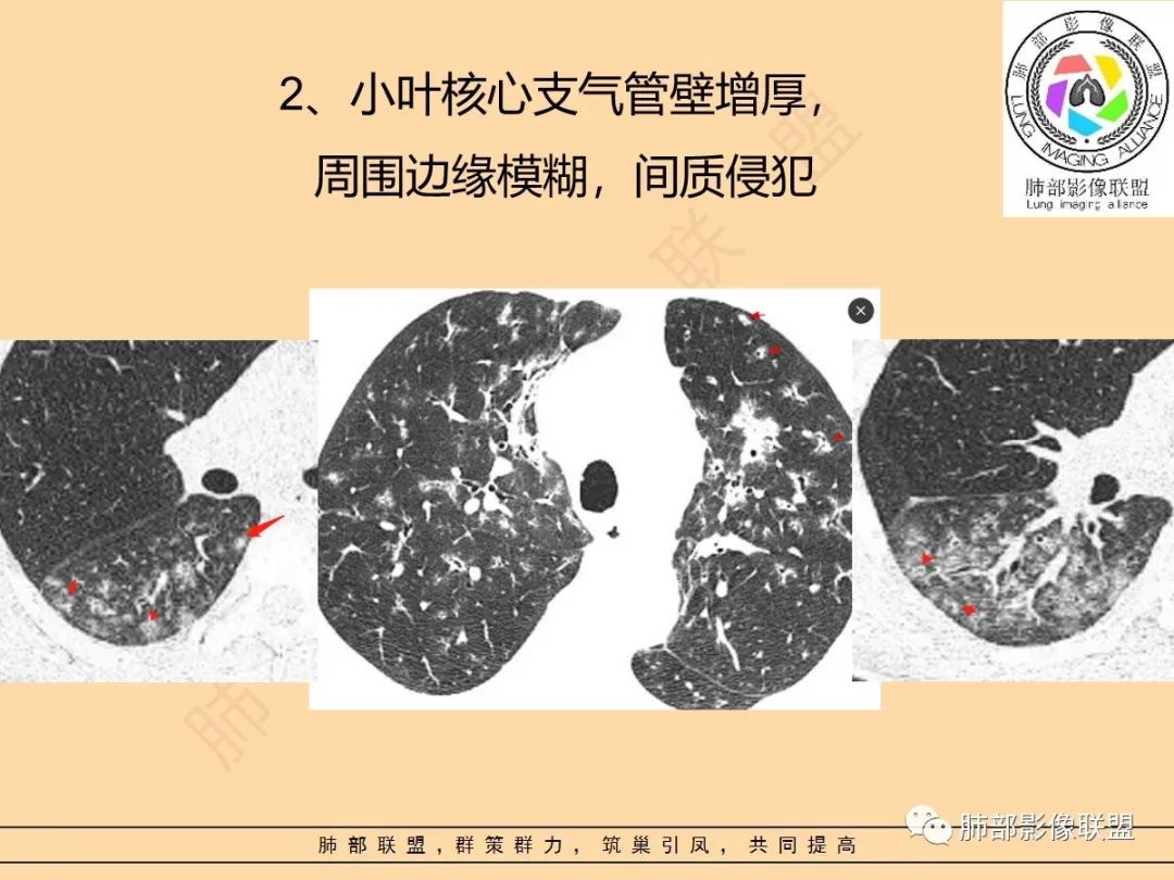 影像PPT - 【PPT】肺炎支原体肺炎影像分析-14 影像PPT - 【PPT】肺炎支原体肺炎影像分析-14