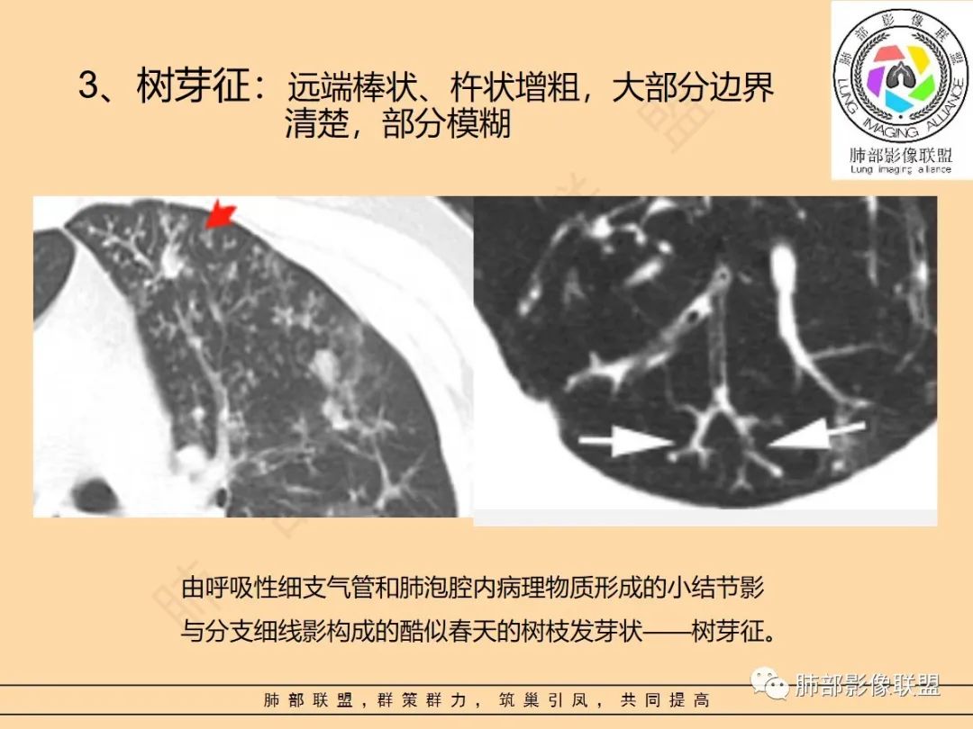 影像PPT - 【PPT】肺炎支原体肺炎影像分析-15 影像PPT - 【PPT】肺炎支原体肺炎影像分析-15